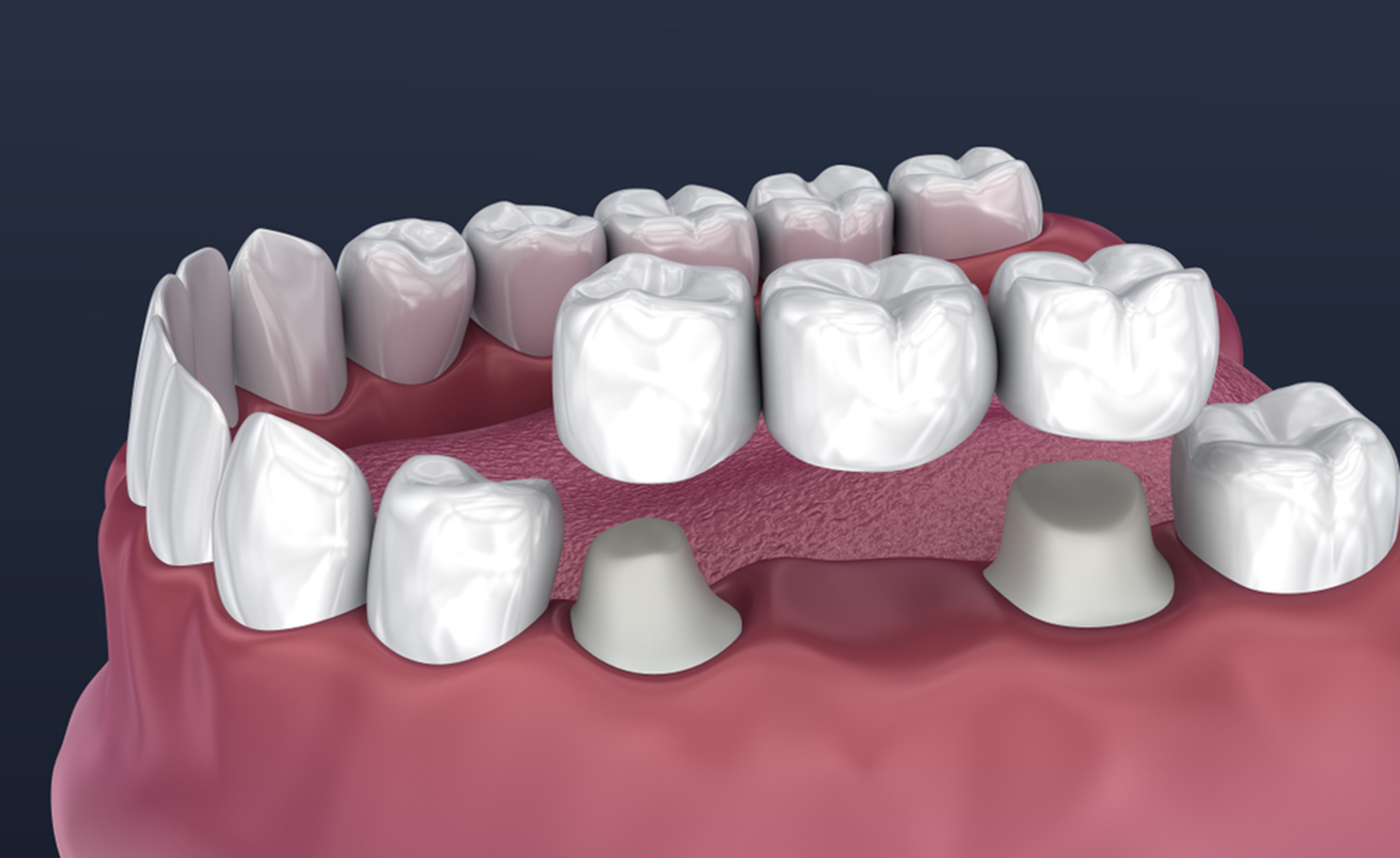 Dental Crowns & Bridges