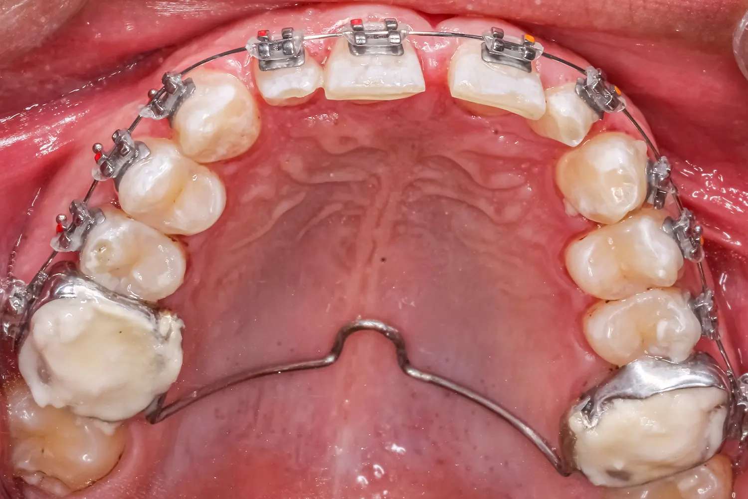 Expander Therapy