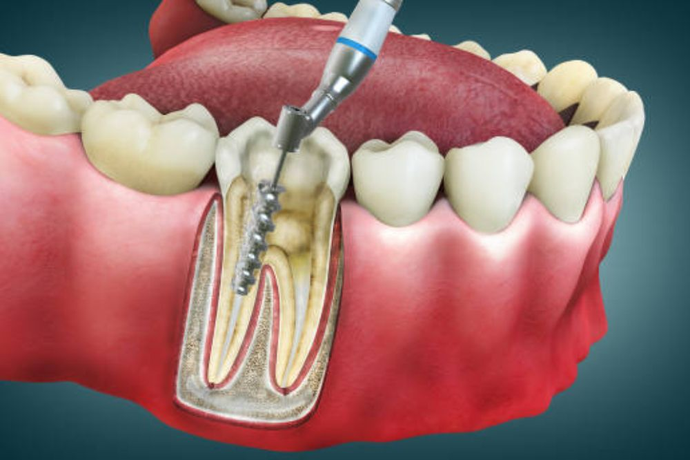 Root Canal Therapy